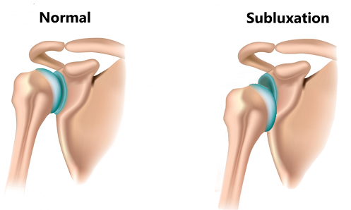 shoulder-dislocation-sublux-1301x670